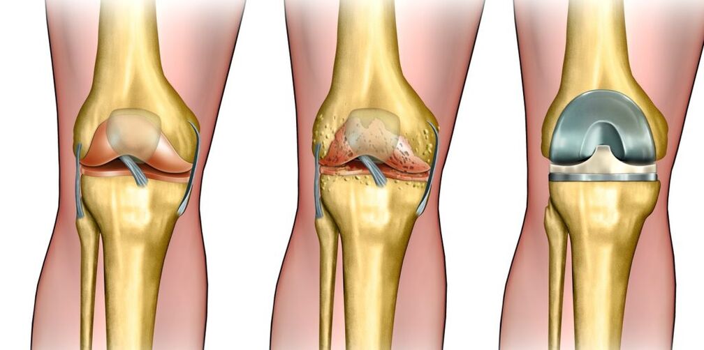 Arthrose des Kniegelenks